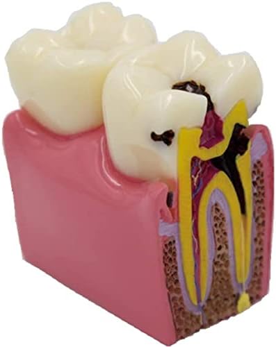 NBDZ Diş Çürüğü Diş Modeli, Diş Patoloji Modeli 6 Kez Büyütme Diş Aletleri Doktor-Hasta İletişim Öğretim Araçları